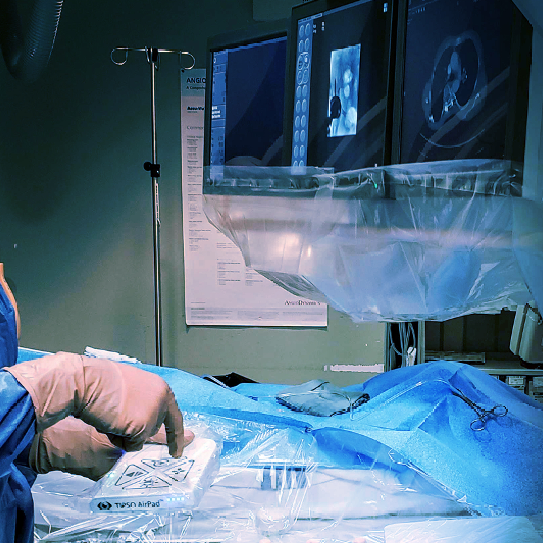 TIPSO™ Featured on Endovascular Today